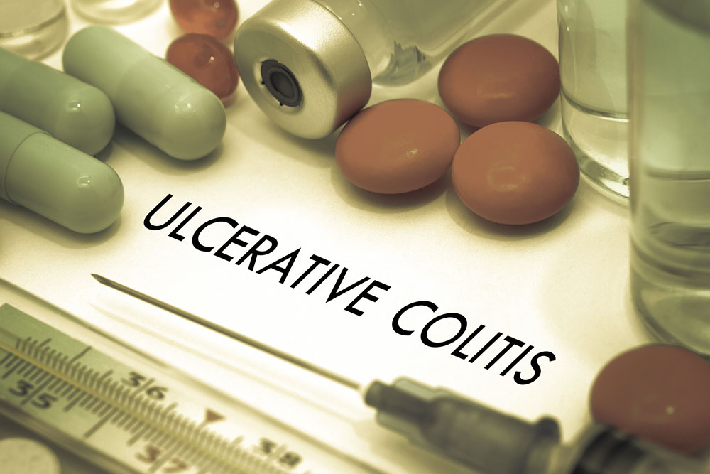 Causes and Complications for Patients with Ulcerative Colitis