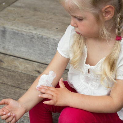 Natural Treatments to Treat Atopic Dermatitis in Kids