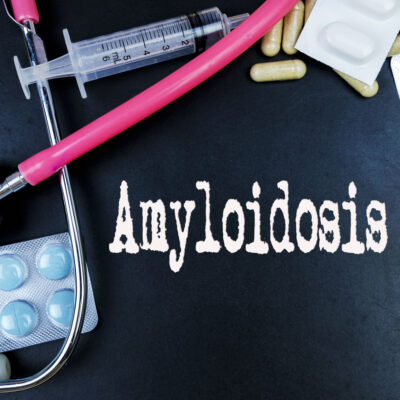 Treatment Methods for Amyloidosis