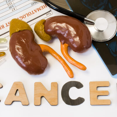 What to Know About Kidney Cancer